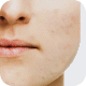 Acne Vulgaris